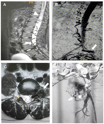 Endovascular treatment of epidural arteriovenous fistula associated with sacral arteriovenous malformation: case report